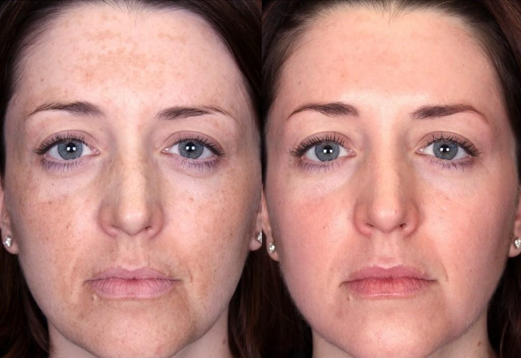 Triluma RD Cream: Triple Combination Therapy for Melasma and Hyperpigmentation